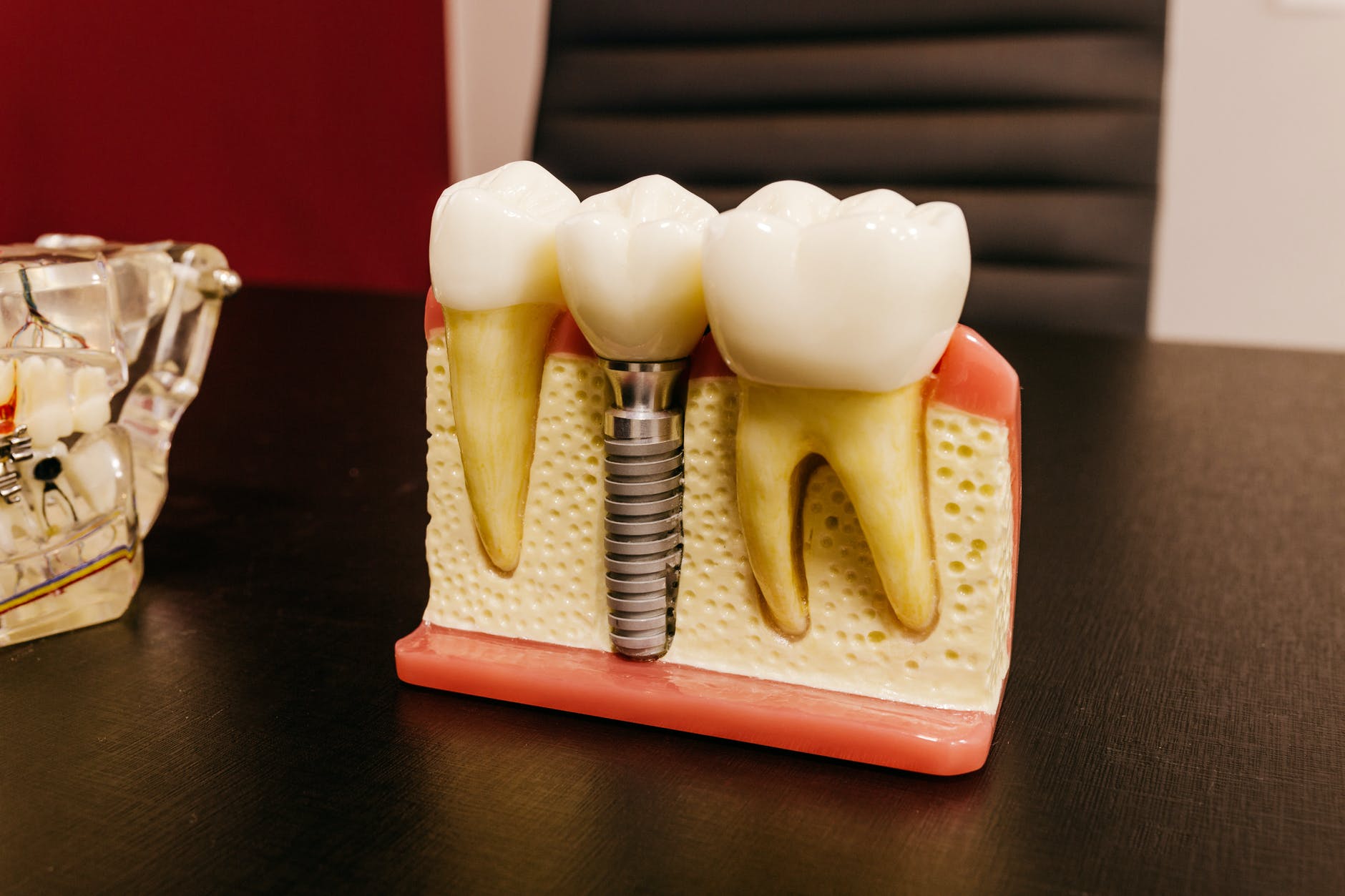 názorný zubní implantát